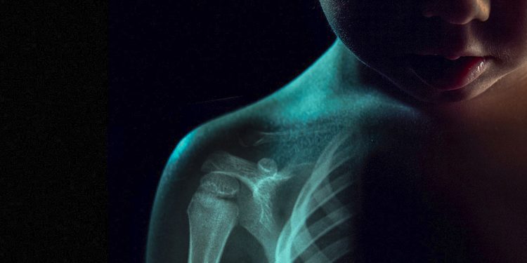 Autoimmune diseases in kids