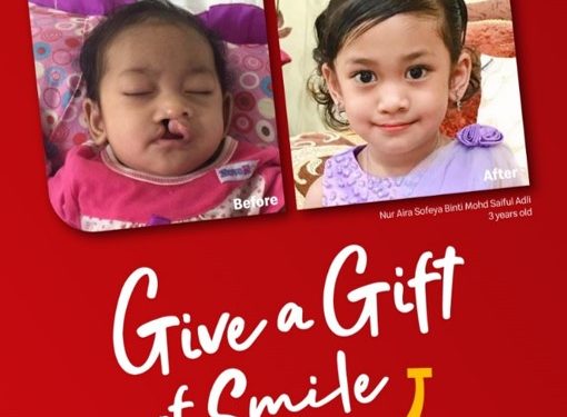 Ronald McDonald’s cleft lip challenge