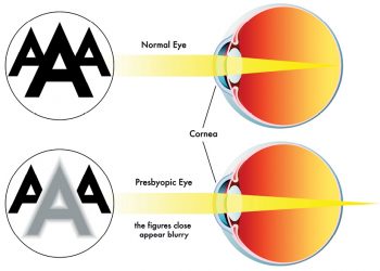 What is presbyopia?