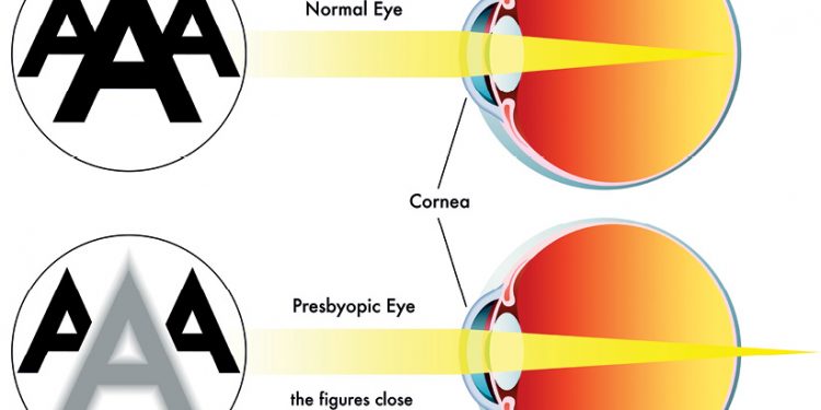 What is presbyopia?