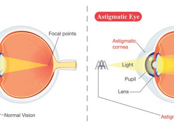 Astigmatism explained