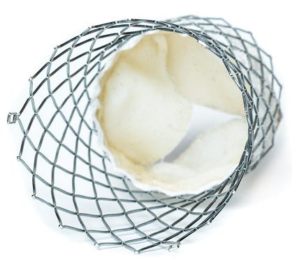 IJN performs innovative heart valve treatment