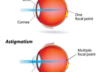 Understanding astigmatism is vital